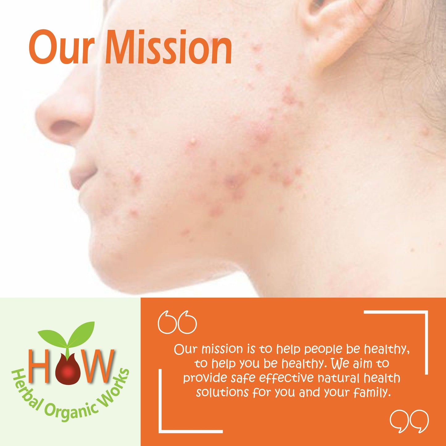 ACNE AND PIMPLES SOLUTION-(HOW38)