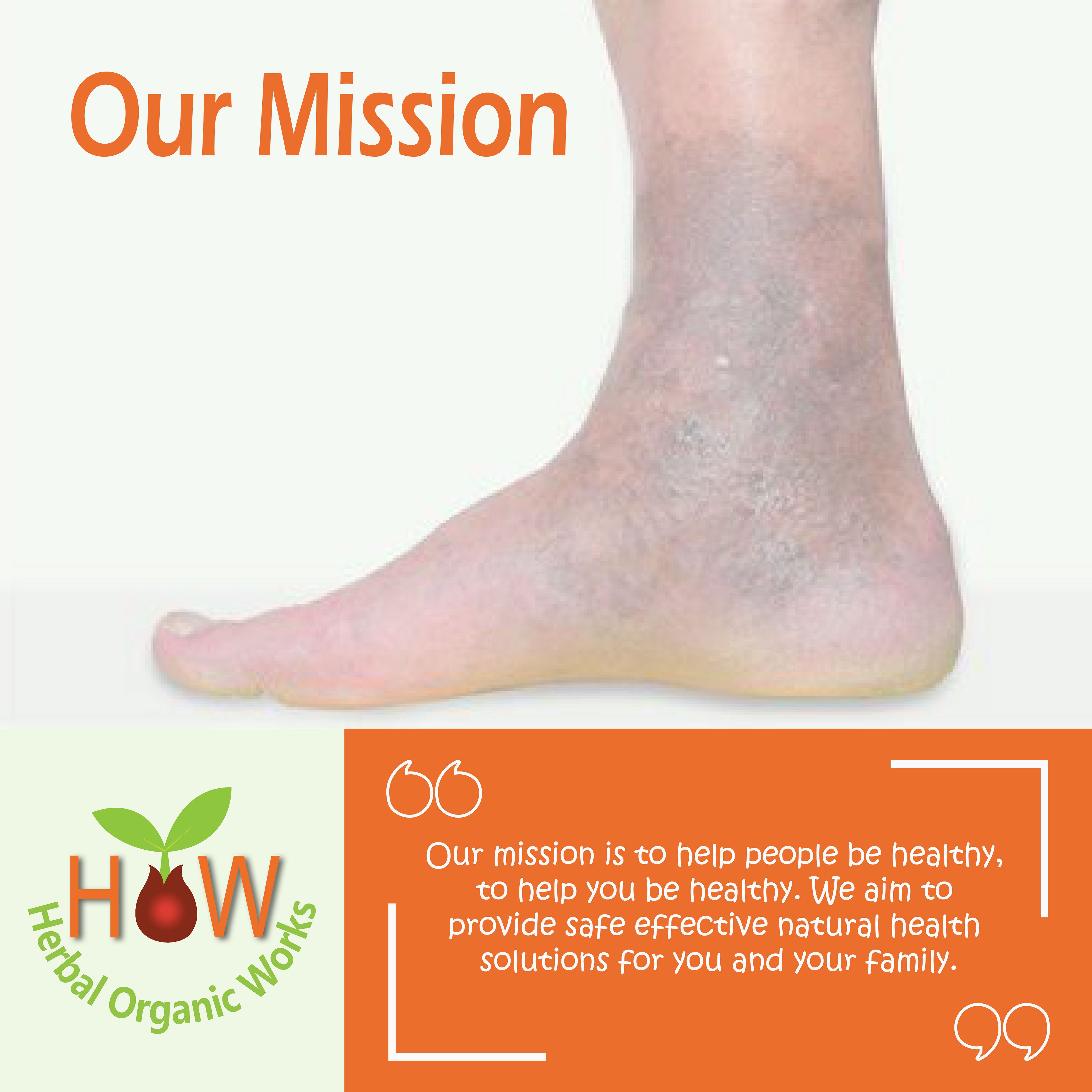 VARICOSE VEINS & ULCERS REMEDY (HOW31)